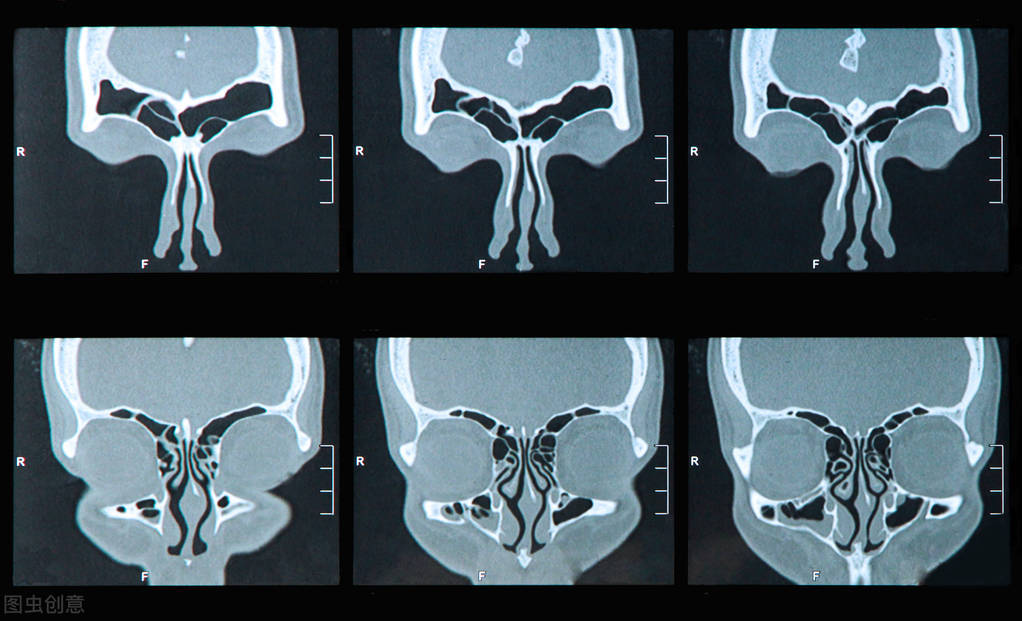 听说有几种小病拖久了会发展成癌,鼻窦炎严重了会变成鼻窦癌吗