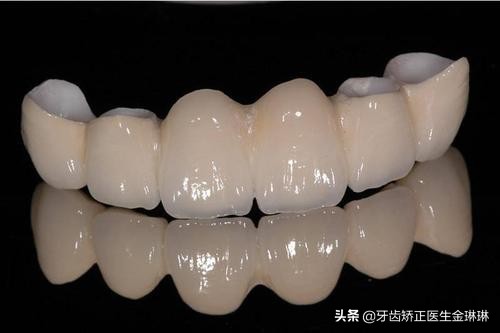 做的烤瓷牙根部发黑了怎么回事,做的烤瓷牙很久了牙根疼怎么回事