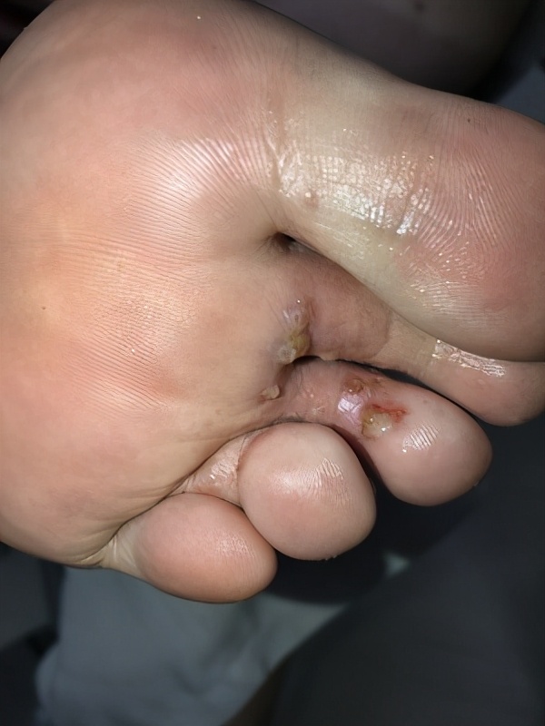 脚气发作难忍,脚气奇痒是什么原因