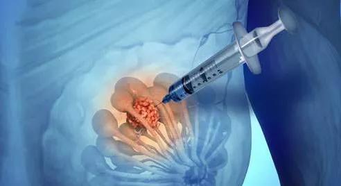 乳房活检过程要多久,乳房活检的过程要多久