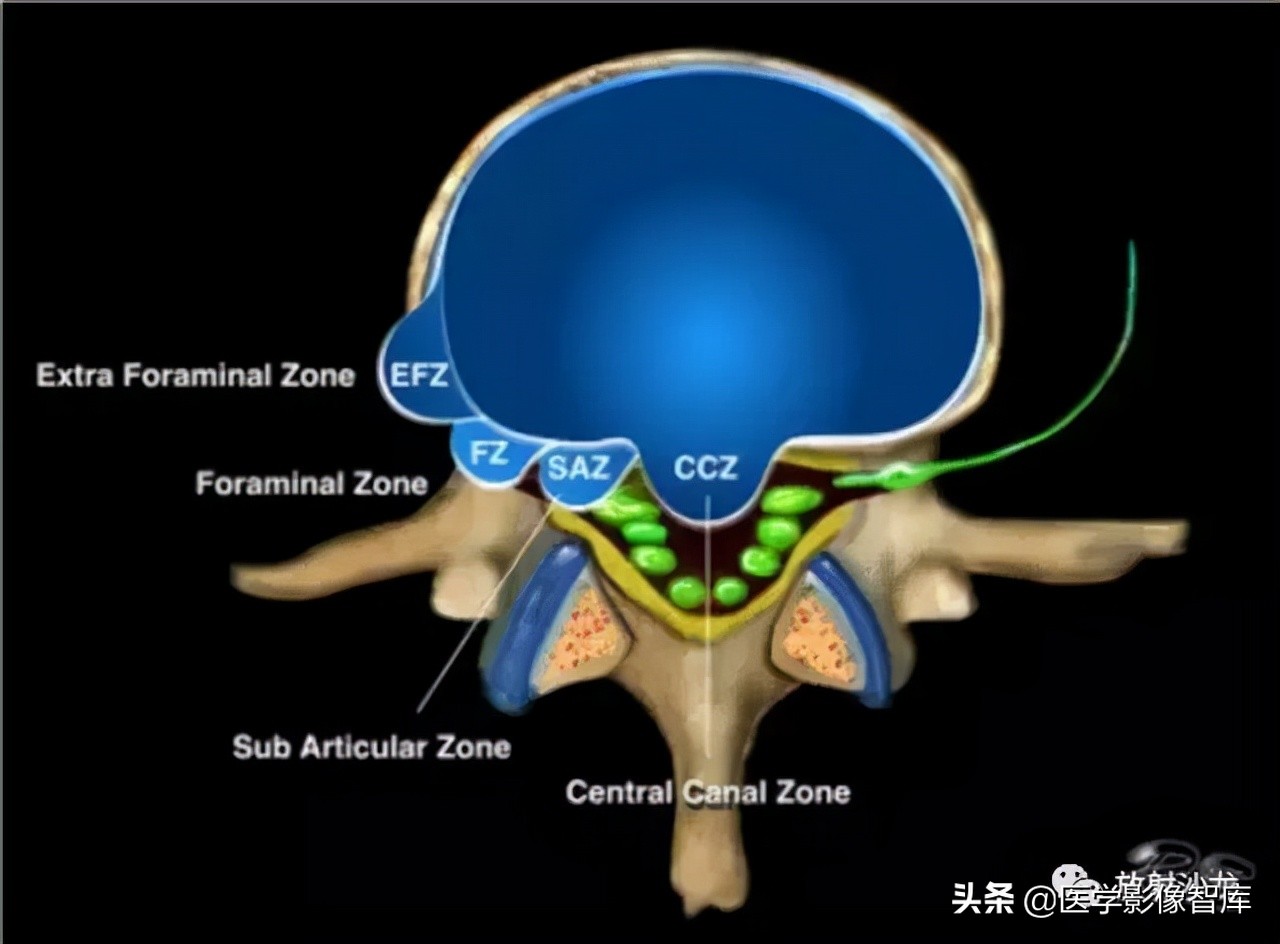 一键收藏所有的内容,颈椎间盘病变的症状和治疗