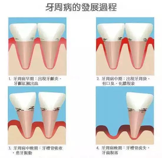 Helen齿科中心——刷牙经常出血是怎么回事