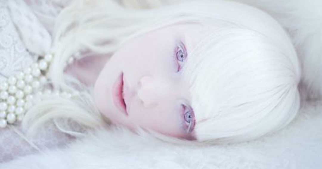 缺少黑色素但不是白化病,体内黑色素过少会引起白化病吗