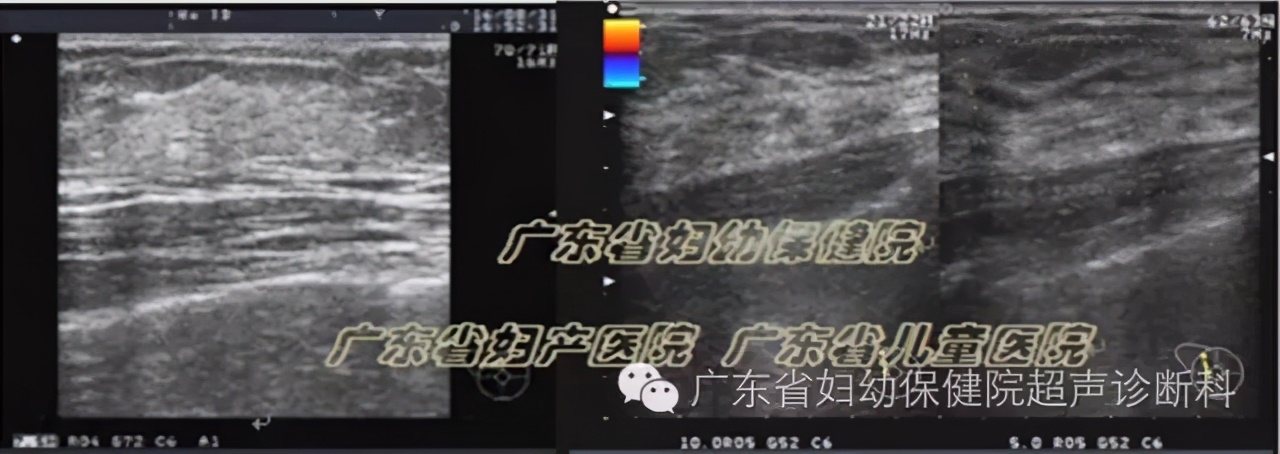 青春期乳腺正常情况,乳腺发育的特征