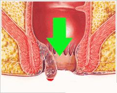 肛门坠胀老是有便意排不出来,肛门坠胀老有便意感觉有气排不出