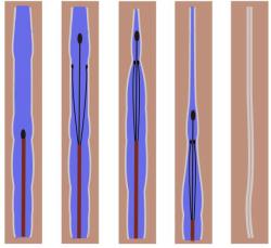 下肢静脉曲张拖着不治行不行,下肢静脉曲张不用药能治好吗