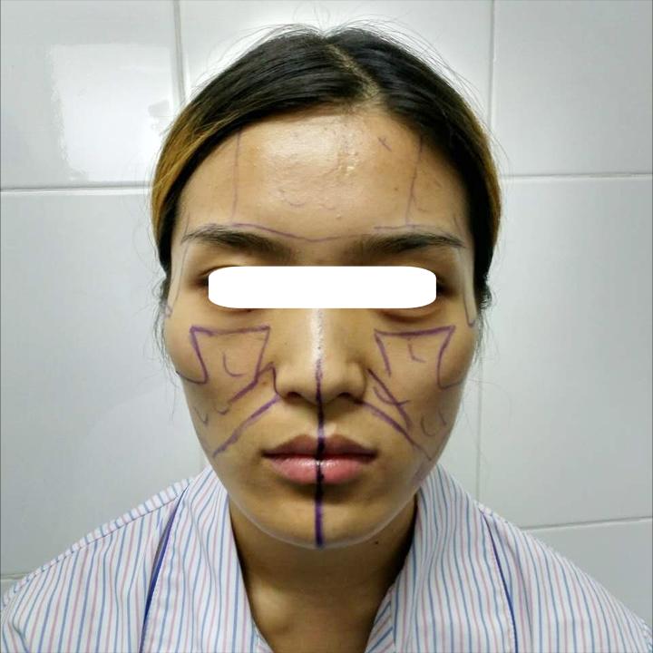 明星为啥要做脂肪填充鼻子,为什么明星喜欢整容