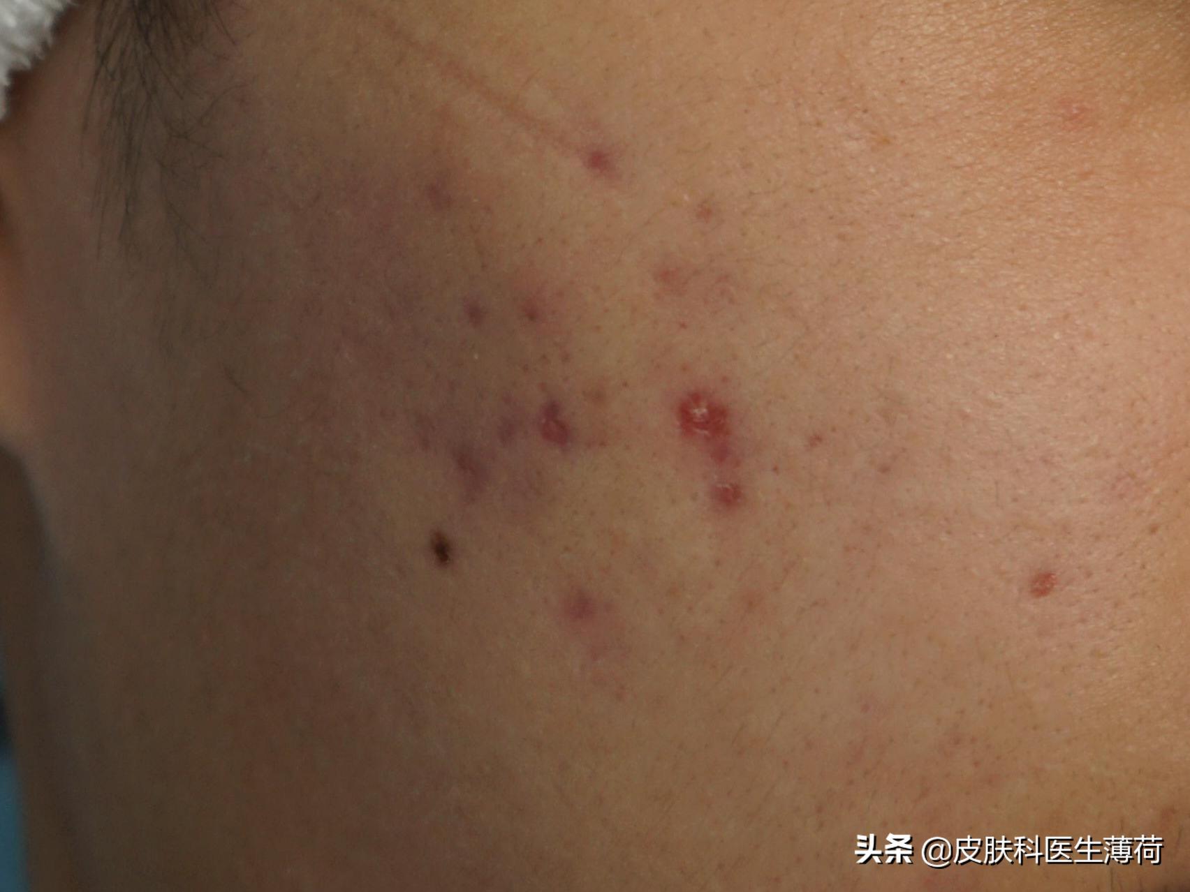 皮肤科医生教你祛痘印,医院的皮肤科主治痘痘痘印吗