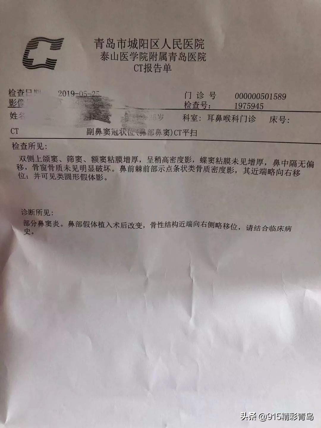 诺德整形医院失败案例,诺德整形鼻子