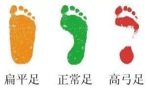 儿童扁平足的最佳治疗方法,全国治疗扁平足前十的医院