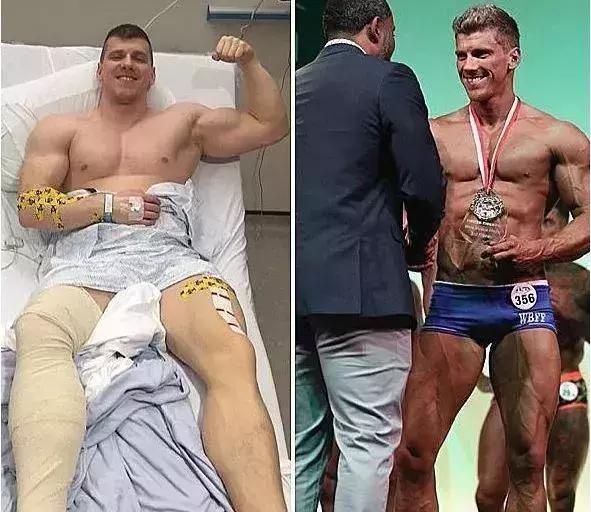 26岁健美冠军小腿静脉爆裂,22岁小伙健身过猛导致内脏撕裂