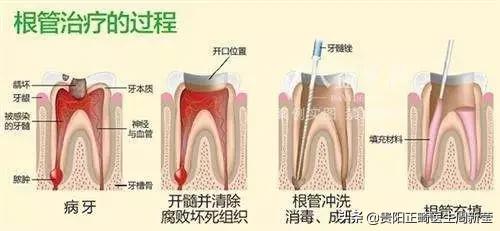 看牙为什么这么贵，牙痛的七个阶段决定你看牙的费用