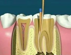 根管治疗会彻底吗,根管治疗真的安全吗