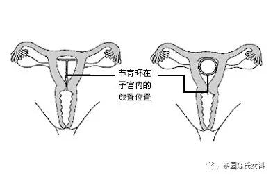 绝经后没取节育环出血是什么原因,绝经了啥时候取避孕环