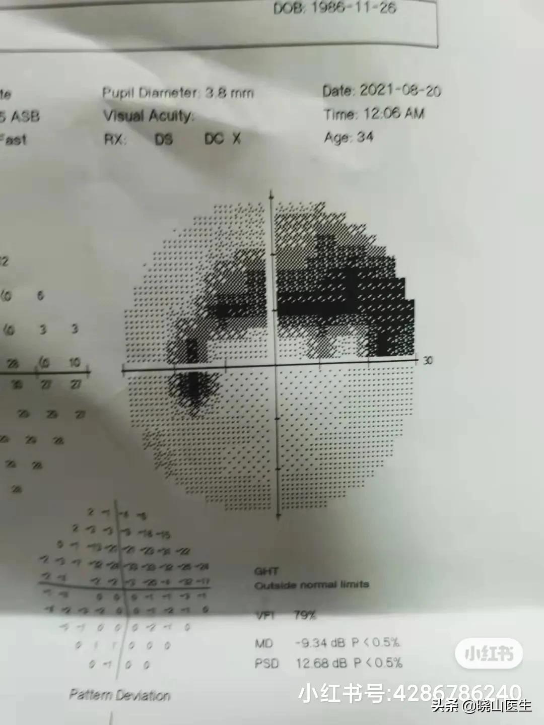 眼底检查塌陷,眼底筛查充血