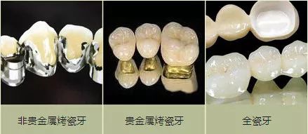 烤瓷牙做什么样的性价比高,沈阳烤瓷牙哪家便宜又好