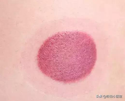 中医火罐疗法有哪些注意事项,中医火罐穴位图