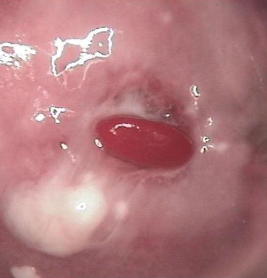 最近两天发现宫颈长异物了,应该怎么办呢?