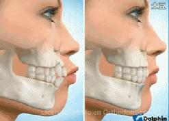 牙套要不要戴久一点再摘,牙套戴多久才不刮嘴