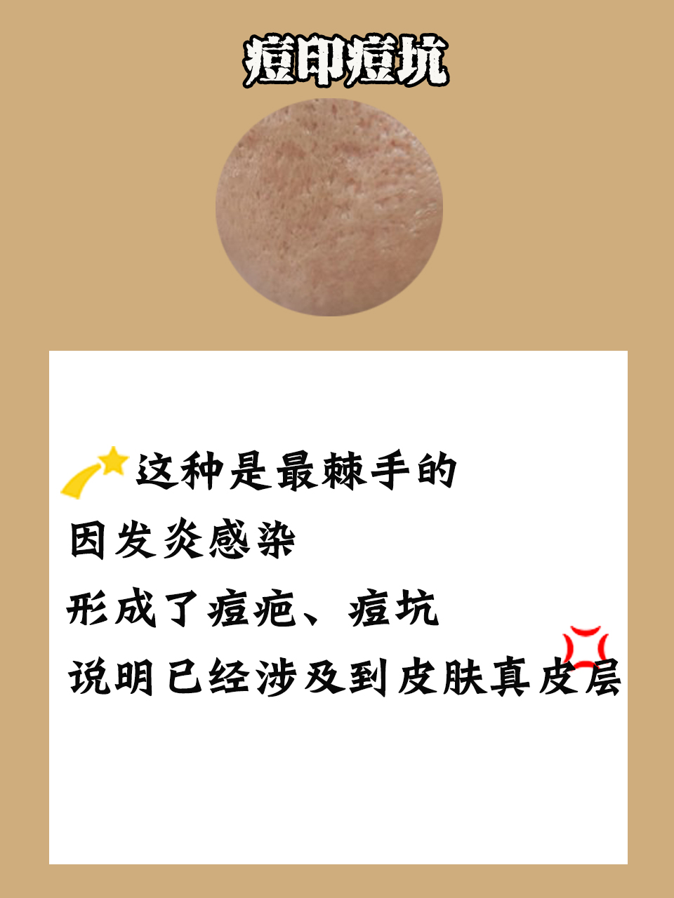 一夜祛痘印方法,祛痘印方法一周见效