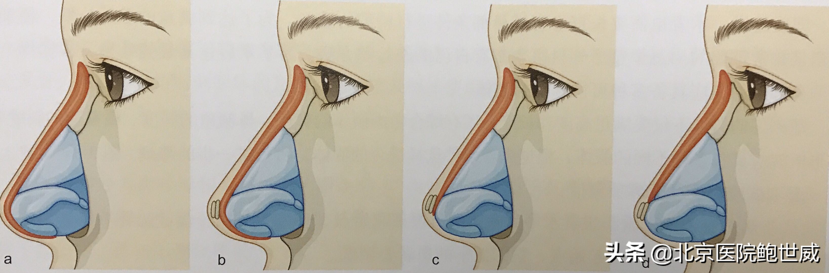 隆鼻为什么会假体外露,假体隆鼻外露怎么修复