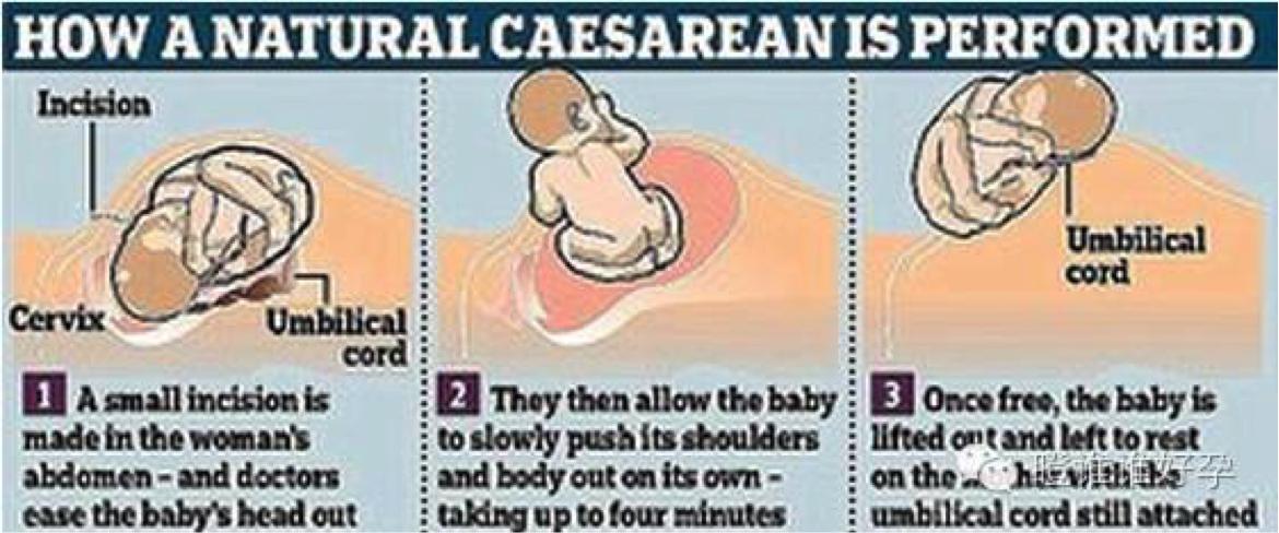 分娩切开胎盘,正常分娩接生的步骤