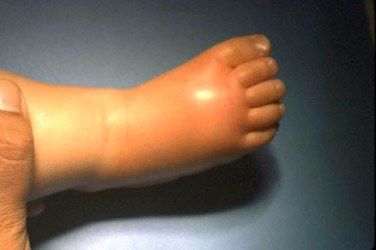 百白破和百白破hib是免费的么,白破百白破区别