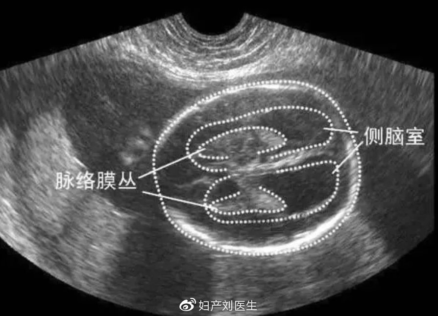 胎儿右侧脑室增宽是什么原因,侧脑室增宽的胎儿生下来实例