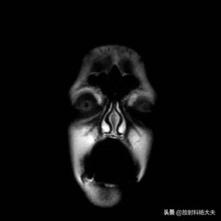 脑出血几年以后复发,脑出血几年后偏瘫越来越严重