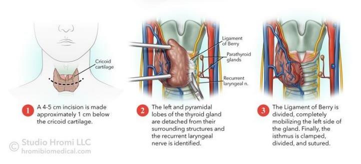 甲状腺术后最危急的并发症是,甲状腺术后六个常见并发症