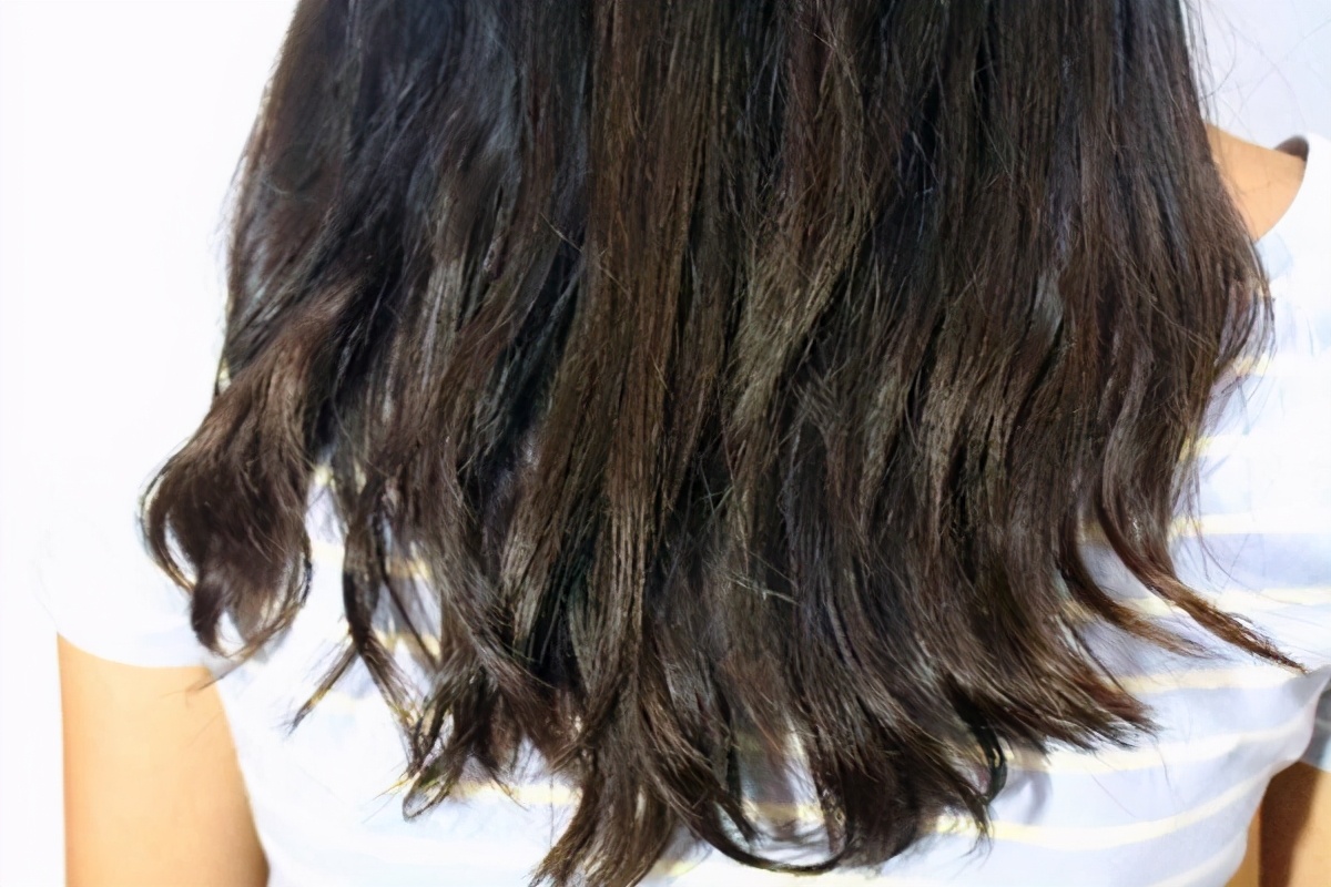 大片头皮屑又痒怎么办,头皮屑真多怎么去除最简单方法