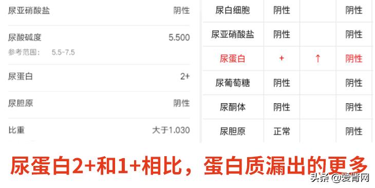 老人尿蛋白3+是怎么回事,孕晚期尿蛋白3+什么原因