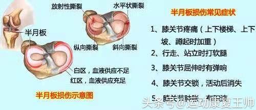您有一份健康体检指南请查收,交叉韧带半月板损伤康复训练方法