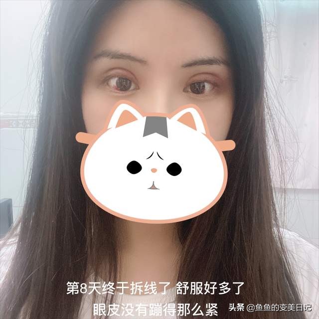 双眼皮知识点总结大全,关于双眼皮的十大真相