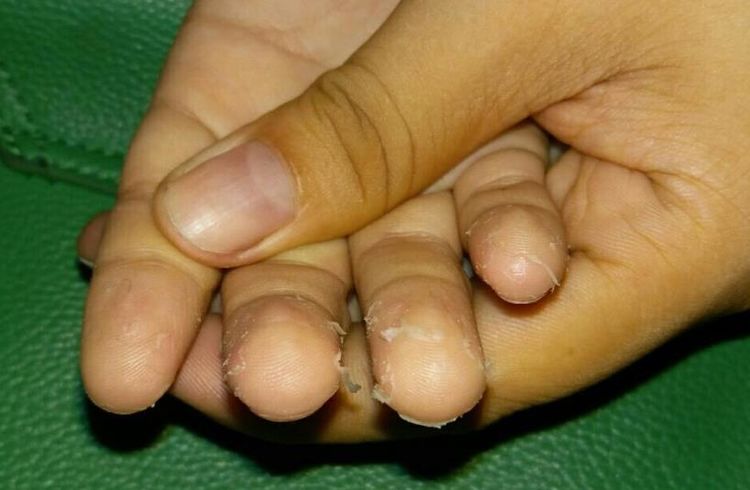 孩子手脚干燥脱皮发红怎么回事,小孩手脚脱皮是什么原因怎么治