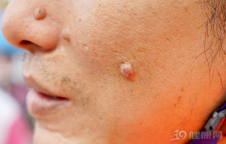 什么痣会转变为黑色素瘤,什么样子的痣会变成黑色素瘤