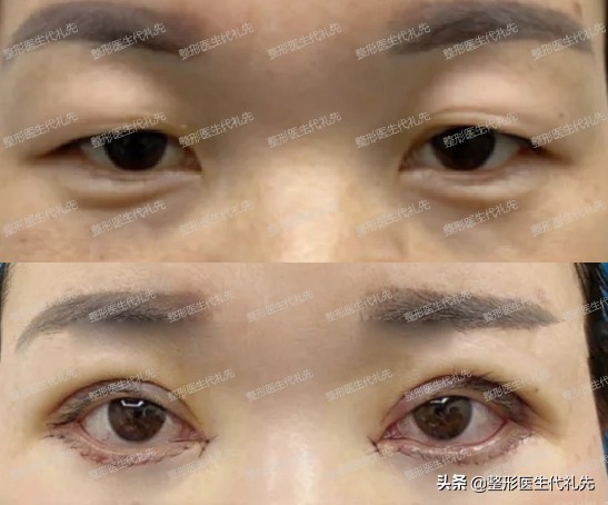 做眼袋提眉眼睑外翻怎么办,祛眼袋眼睑轻度外翻悬吊多久能好