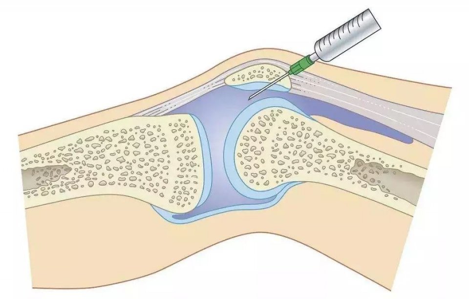腿疼膝盖骨刺的最快解决方法,膝盖骨刺关节炎疼痛解决最好办法