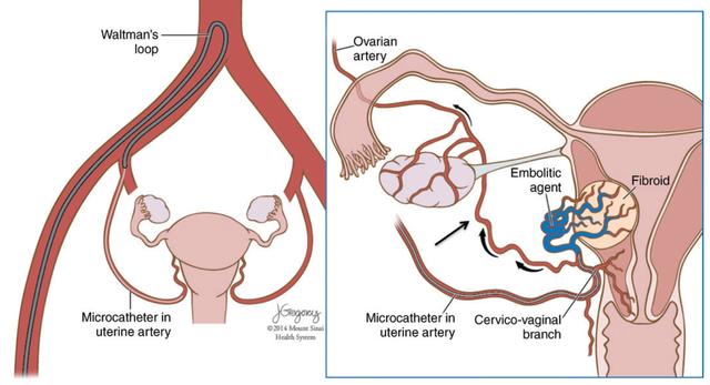 子宫肌瘤介入栓塞术排出黄水,子宫肌瘤介入消融治疗