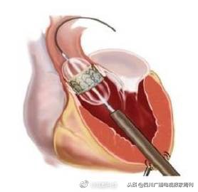 脂溢性脱发的福音,华西治疗脂溢性脱发价格