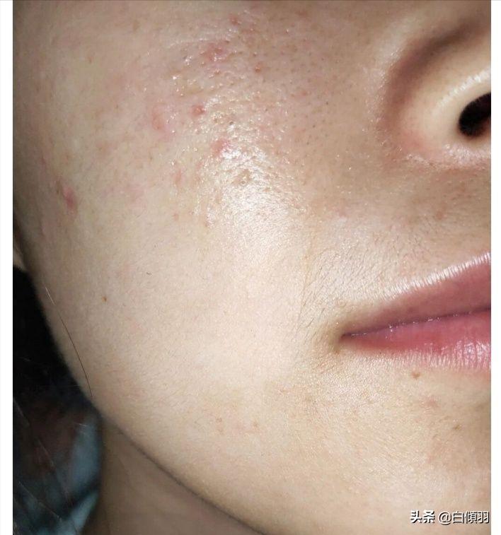 乱用水杨酸怎么办,用水杨酸软膏有危害吗