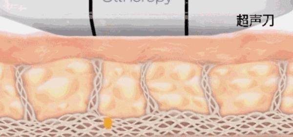 超声刀对皮肤有伤害吗,超声刀做的是哪一层的皮肤