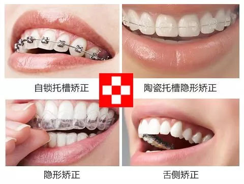 什么叫做矫正牙,什么是牙齿矫正过程