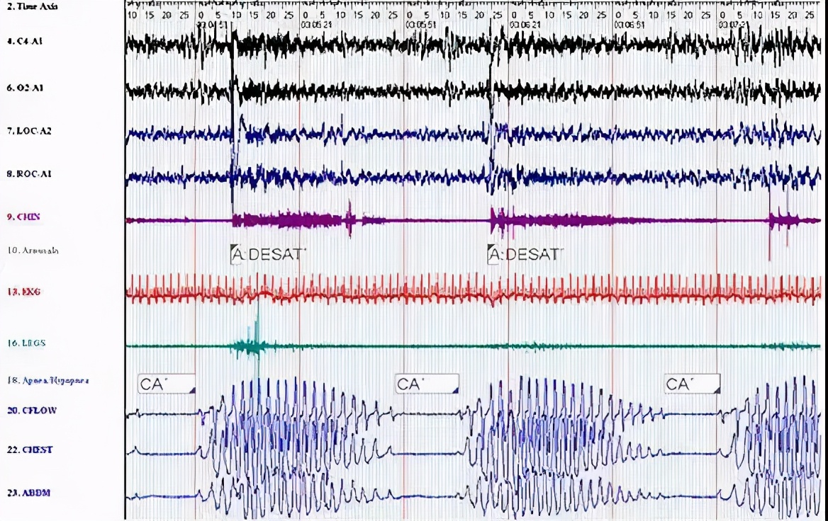 睡觉时尖叫或恐慌时要叫醒吗,睡觉惊醒尖叫怎么回事