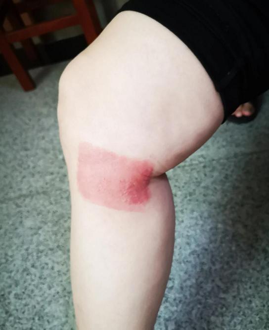 膝盖关节炎腿疼有什么好的方法吗,膝盖关节炎有骨刺怎么治疗