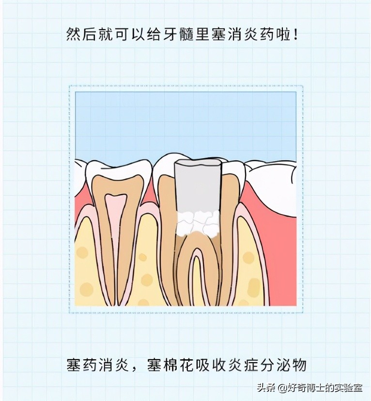 治牙到底有多恐怖,治牙有多痛苦