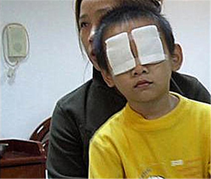 小孩子眼睛被撒了石灰怎么处理,孩子眼睛落入生石灰应该怎么办