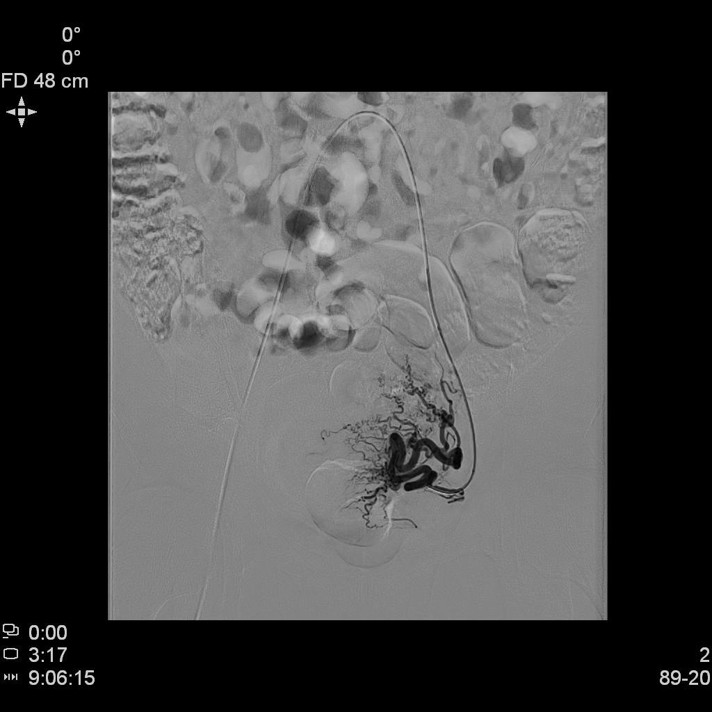 子宫肌瘤介入栓塞术排出黄水,子宫肌瘤介入消融治疗