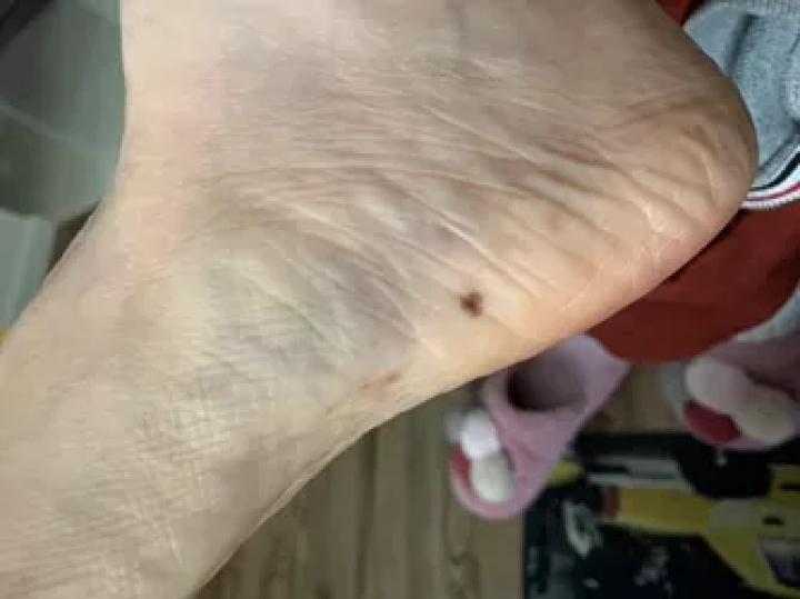 哪些部位长痣预示一生劳碌,痣的位置预示着什么