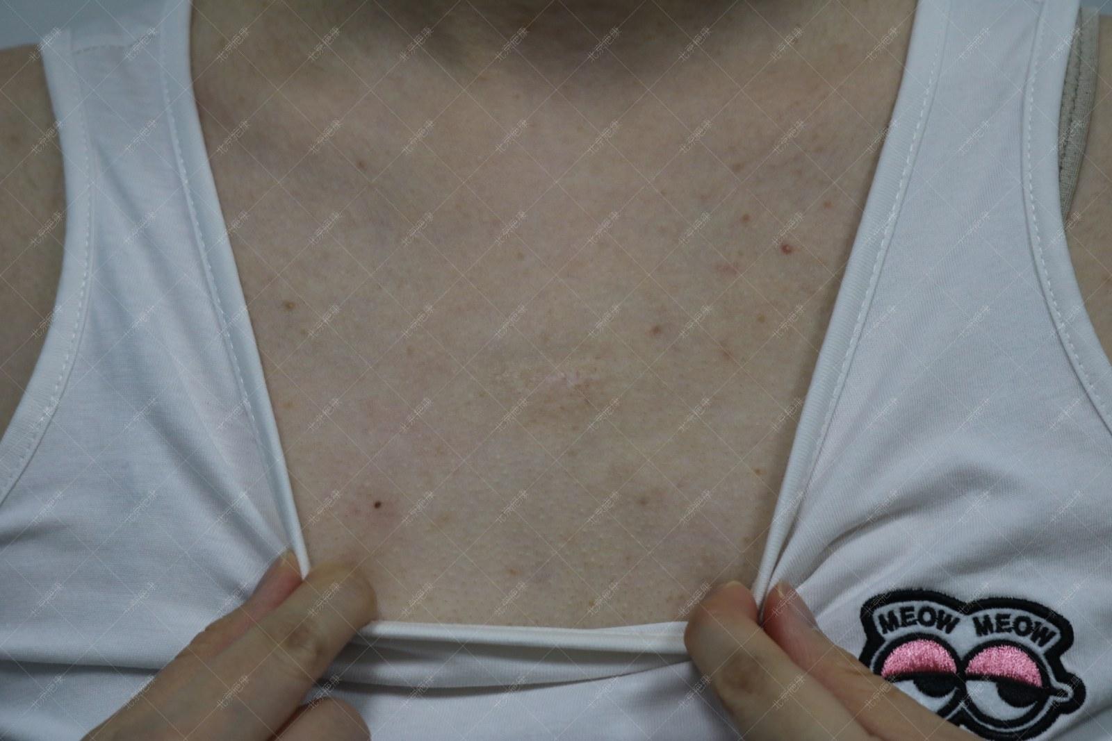 北京疤康怎么治疗疤痕,疤康医院治疗疤痕增生如何